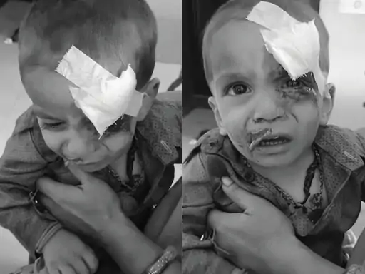 उदयपुर में आवारा कुत्ते का कहर: 1 किमी दायरे में 4 लोगों पर हमला, 3 साल के बच्चे की हालत गंभीर
